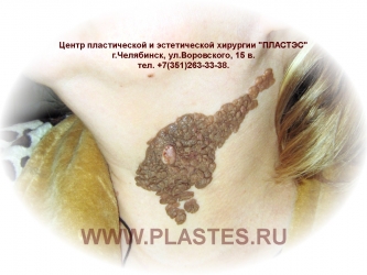 Врожденный пигментный невус
