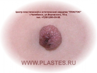 Диспластический невус кожи